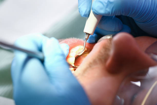 Best Emergency Dental Care for Broken or Chipped Teeth in Massanutten, VA