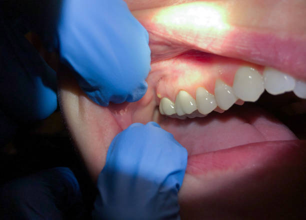 Best Emergency Gum Treatment in Massanutten, VA