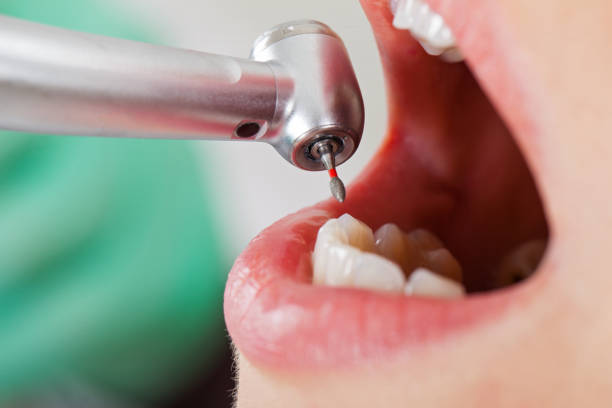 Best Emergency Treatment for Dental Infections or Abscesses in Massanutten, VA